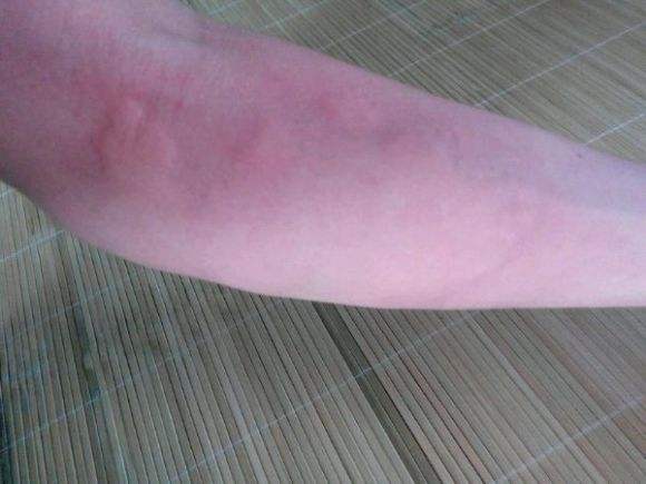 荨麻疹的治疗方法有什么-昆明太医堂皮肤病医院